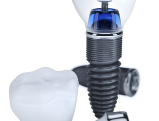 Metody implantacji zębów