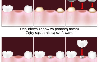 Porównanie implant a most na zębach sąsiednich