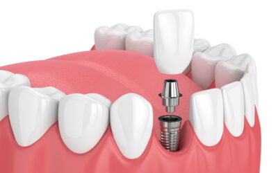 Stary implant bez korony