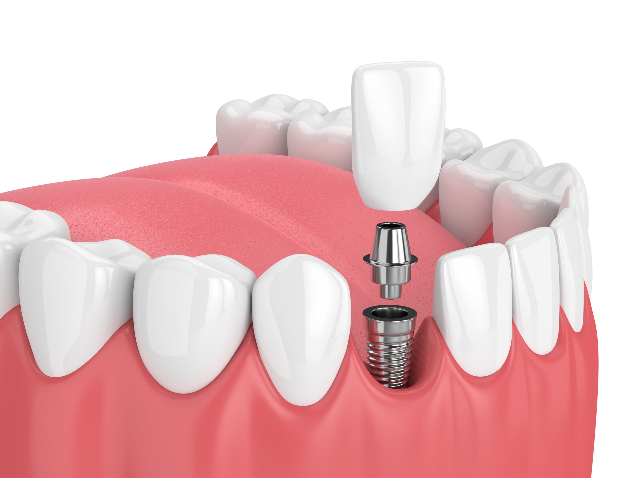 Demed Stomatologia - implant korona